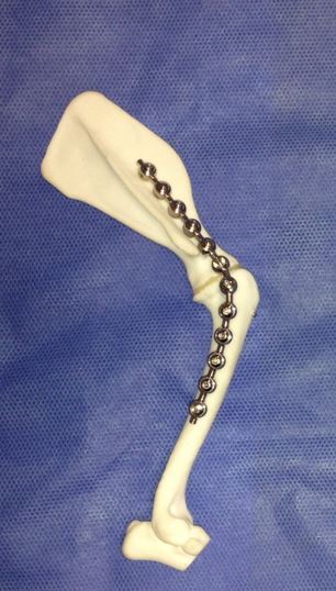 bone model created from the CT scan 